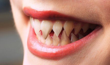 Pleonastic Mutation - Serrated Teeth