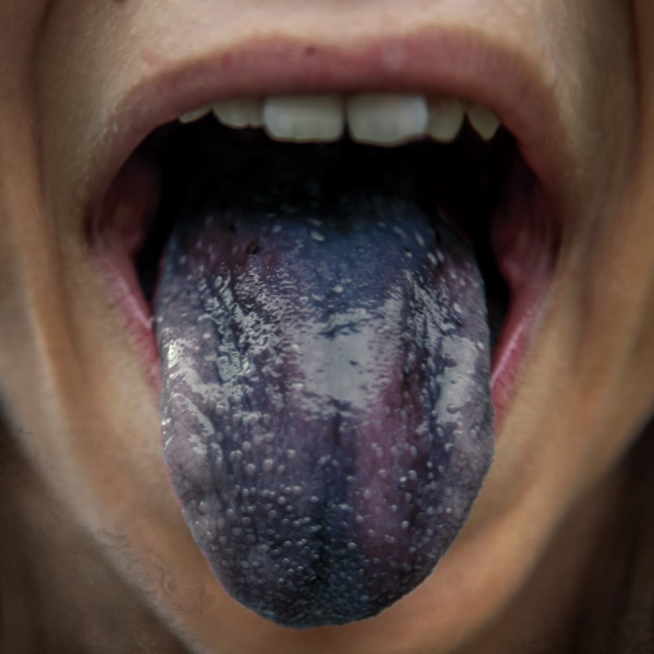 Blue tongue madness condition